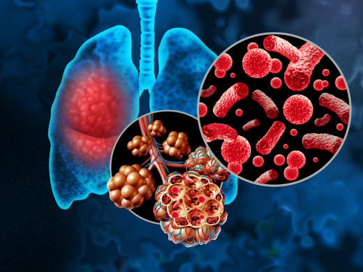 Těžký zápal plic ohrožuje cukrovkáře, kardiaky i astmatiky