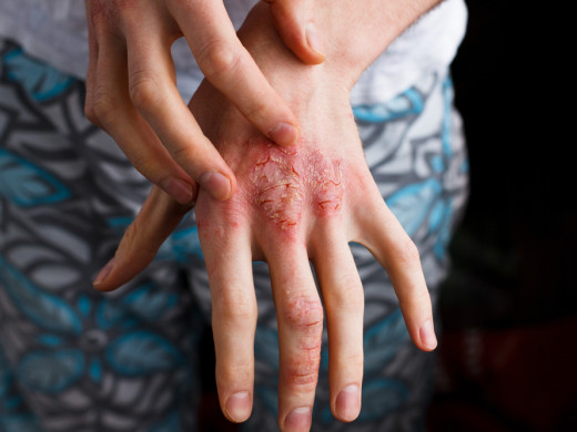 Kardiovaskulárne komorbidity pri atopickej dermatitíde